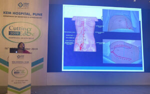 Best Surgical Treatment for Endometriosis with Dr Shweta Raje